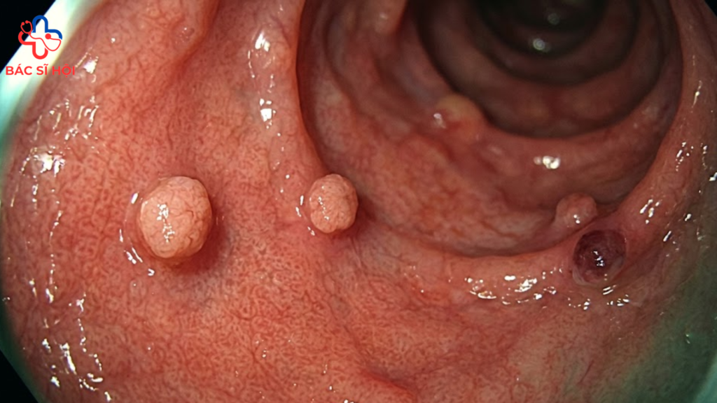 Polyp dạ dày