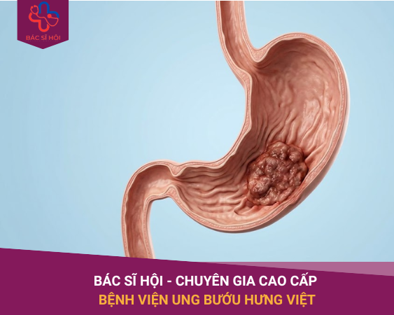 Ung thư dạ dày có biểu hiện gì? Nhiều người phát hiện quá muộn vì nhầm với đau dạ dày thông thường